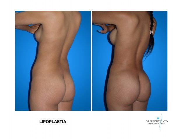 LIPOPLASTIA1