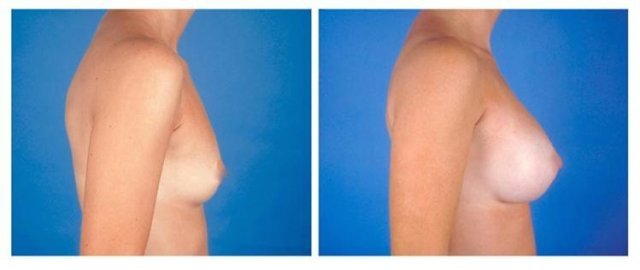 mamoplastia1