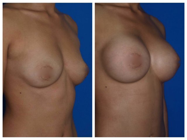 mamoplastia2
