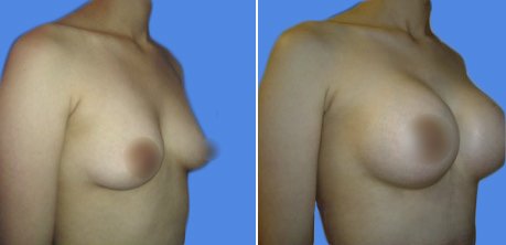 mamoplastia de aumento