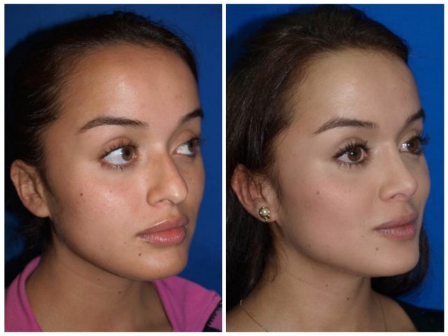 Rinoplastia3