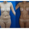 ABDOMINOPLASTIA2