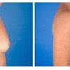 mamoplastia1