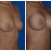 mamoplastia2