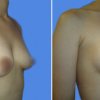 mamoplastia de aumento