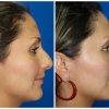 RINOPLASTIA1