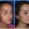 Rinoplastia3