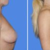 mamoplastia de aumento