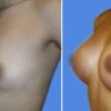 mamoplastia de aumento