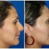 rinoplastia3